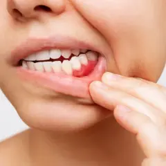 Encía inflamada y enrojecida, con signos de sangrado, quizás por el uso incorrecto del hilo dental.