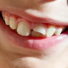 Sonrisa de niño con un diente partido por la mitad, mostrando que se puede arreglar.
