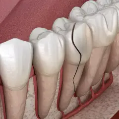 Dientes delanteros con grietas visibles, mostrando el daño en el esmalte y la pulpa.