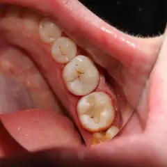 Boca con molares empastados, mostrando la importancia de la prevención de caries para mantener una sonrisa sana.