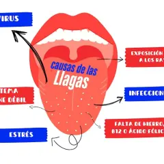 Ilustración de boca abierta mostrando la lengua con puntos, con flechas que señalan las ampollas en la boca causas: virus, sistema inmune débil, estrés, exposición UV, infecciones, falta de hierro/B12/ácido fólico.