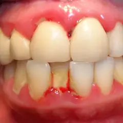 Encias inflamadas y enrojecidas, con acumulación de sarro y restos de comida, evidenciando encias sucias.