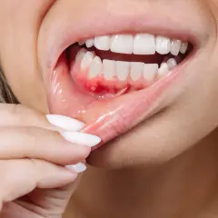 Una persona se revisa la boca, mostrando una llaga roja y dolorosa en la encía picada.