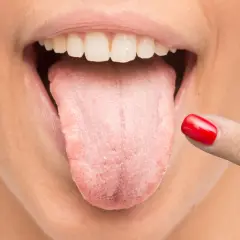 Dedo con uña roja señala lengua con aspecto blanquecino, sugiriendo la necesidad de un enjuague antifúngico.