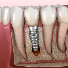 Ilustración de un implante dental con bolsas inflamatorias alrededor, mostrando la pérdida ósea y la irritación de los tejidos.