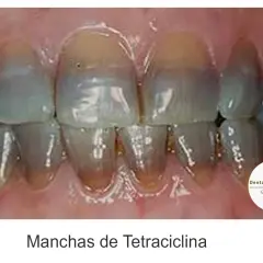 Dientes con manchas verdes y amarillas, indicativo de manchas de tetraciclina.
