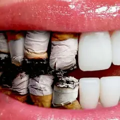 Dientes amarillentos y dañados por el efecto negativo del tabaco en nuestros dientes.