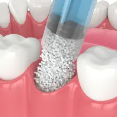 Jeringa aplicando material para poner hueso en la encía, cerca de los dientes.