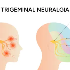 Ilustración muestra el nervio de la boca y sus zonas de afectación en la neuralgia trigeminal, con puntos de dolor en la cara.