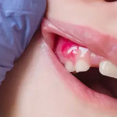 Boca con encía inflamada y un bulto de pus. Un guante azul sujeta la mejilla.