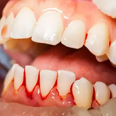 Encías sangrantes alrededor de los dientes, una posible causa de porque sangran las encias de noche.
