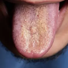 Lengua con capa blanquecina y amarillenta. ¿Cómo saber si me huele el aliento? Podría ser una señal.
