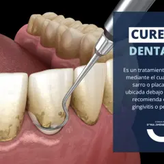 Instrumento dental elimina sarro bajo la encía. El curetaje dental es esencial para tratar la gingivitis y periodontitis.