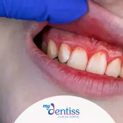 Encías inflamadas y rojas. Aprende como limpiar las encías correctamente para una salud bucal óptima.