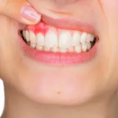 Dedo revela encía gingival inflamada y enrojecida alrededor de dientes blancos.