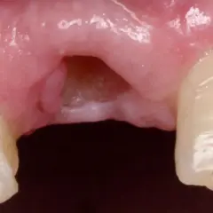 Gingiva con espacio desdentado y dientes adyacentes. Se observa la necesidad de limar diente astillado para mejorar la estética y función.