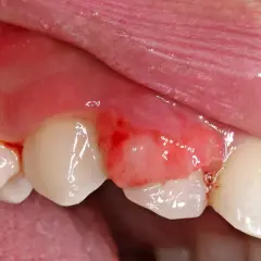 Encía inflamada y enrojecida, con posible sangrado. Podría ser un síntoma de cáncer encias.