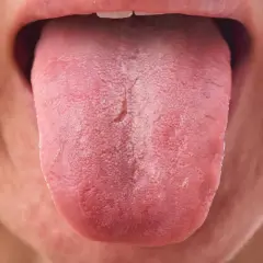 Lengua rosada con una capa blanquecina, posiblemente por uso de clorhexidina.