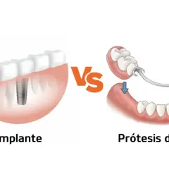 Comparación de implante dental y prótesis para solucionar la falta de dientes.