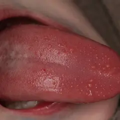 Lengua rosada con múltiples ampollas pequeñas y blancas, algunas rojas, visibles en la superficie.