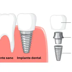 Ilustración de un diente sano y un implante dental con sus componentes: corona, pilar y tornillo dental.