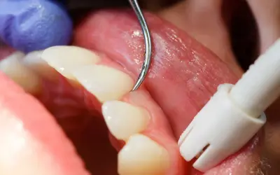 Detalles de un tratamiento dental para como tratar la gingivitis. Un dentista usa un scaler para limpiar los dientes.