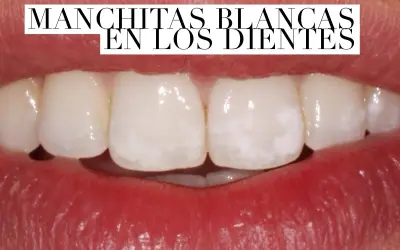 Primer plano de una boca mostrando dientes con manchas blancas.
