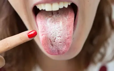 Dedo con uña roja señala una lengua con una llaga blanca, indicando posible candidiasis oral.