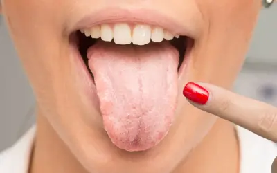 Dedo con uña roja señala lengua con aspecto blanquecino, sugiriendo la necesidad de un enjuague antifúngico.
