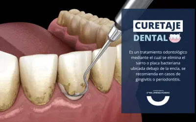 Instrumento dental elimina sarro bajo la encía. El curetaje dental es esencial para tratar la gingivitis y periodontitis.