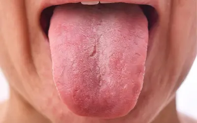 Lengua rosada con una capa blanquecina, posiblemente por uso de clorhexidina.