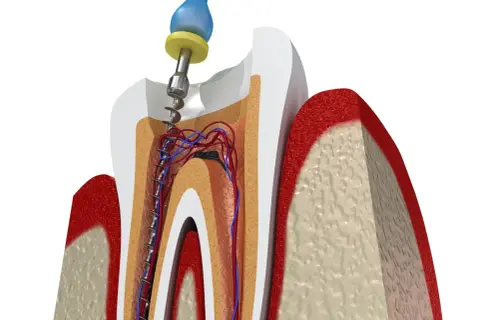 Procedimiento dental para tratar una muela picada, mostrando la limpieza del conducto radicular con una lima.