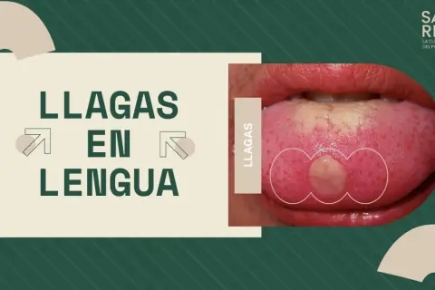 Una llaga con pus en la lengua, destacada en un gráfico que dice "LLAGAS EN LENGUA".