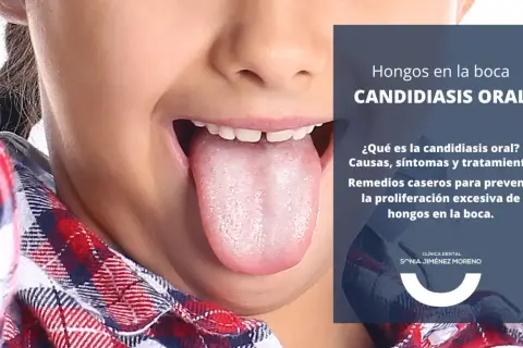 Primer plano de una lengua con aspecto blanquecino, indicando candidiasis oral. El texto informa sobre causas, síntomas y tratamiento.