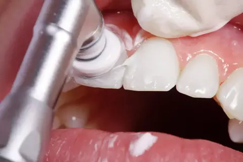 Un dentista pule una carilla dental en la arcada superior dental.