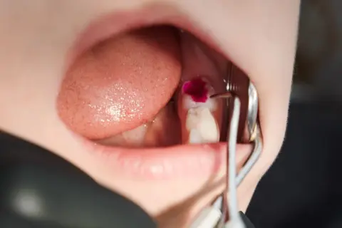 Detalles de cómo se limpia una caries con un tinte revelador y herramientas dentales.