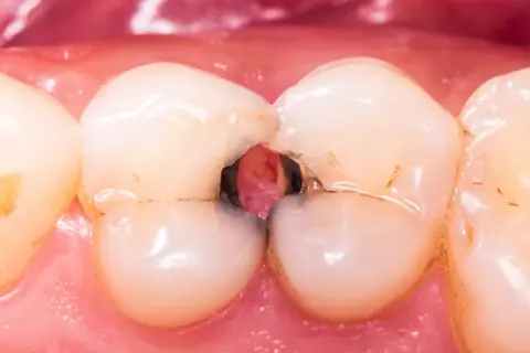 Caries severa en la arcada dental inferior, con cavidades profundas entre los dientes.