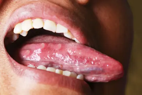 Boca abierta mostrando la lengua con múltiples llagas blancas y rojas, una llaga en la lengua que no se cura.