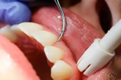 Detalles de un tratamiento dental para como tratar la gingivitis. Un dentista usa un scaler para limpiar los dientes.