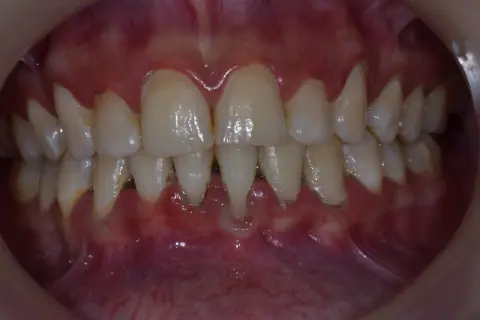 Encías inflamadas y dientes con sarro, signos de periodontitis avanzada, a menudo agravada por el tabaco.