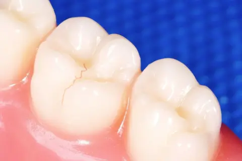 Detalle de una muela con una fisura fina. Aprende como arreglar una fisura en la muela para mantener tu sonrisa sana.