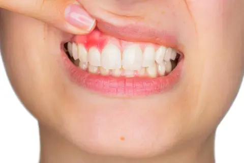Encía inflamada y enrojecida, mostrando un posible flemón sin dolor. Dientes blancos y sanos.