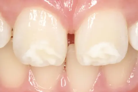 Manchas blancas en las muelas, que no son caries, se ven en los dientes frontales.