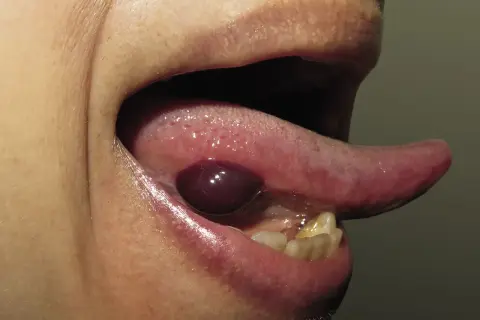 Ampolla oscura y abultada debajo de la lengua, con la lengua extendida.
