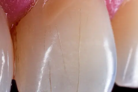 Detalle de dientes con finas líneas verticales que sugieren una infracción del esmalte.
