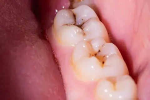 Muelas con caries y empastes. Se observa una muela picada con restos de comida y un empaste dental.