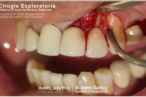 Exploración dental muestra una fractura radicular con tejido de granulación y pérdida ósea vestibular.