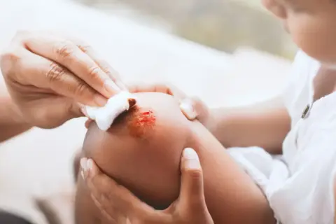 Mano limpia una herida en la rodilla de un niño con clorhexidina, cuidando las pequeñas lesiones.