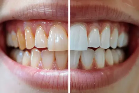 Comparación de dientes: antes amarillentos y después blancos y brillantes, mostrando cómo reforzar el esmalte dental.