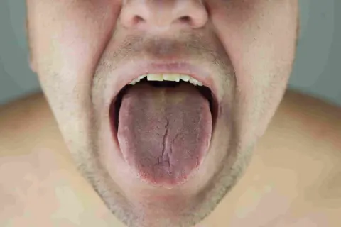 Primer plano de una boca abierta mostrando una lengua con placas y grietas.
